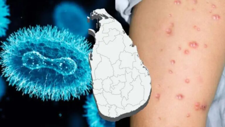 මන්කිපොක්ස් ශ්‍රී ලංකාවට ඇතුළු වෙයි.? සෞඛ්‍ය අමාත්‍යංශයෙන් නිවේදනයක්!