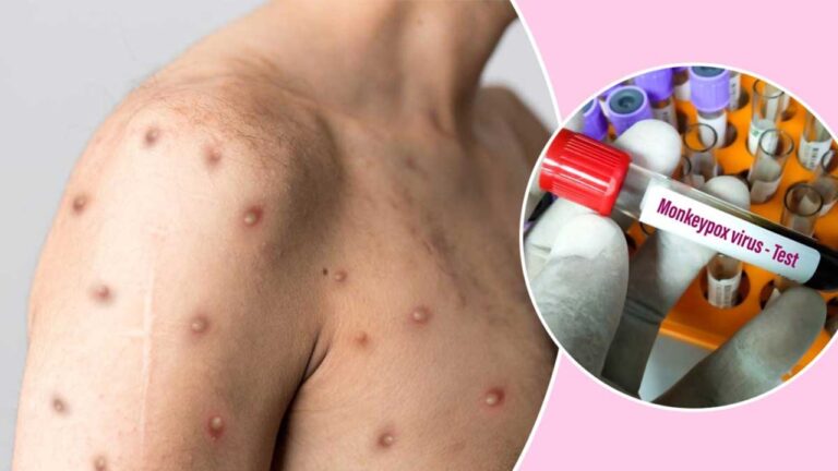 මන්කිෆොක්ස් රටට ඇතුළුවීම නවත්වන්න වැඩපිලිවෙලක් නෑ