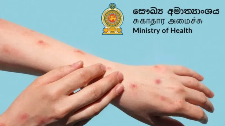 යටගිය වසංගතයක ලක්ෂණ සහිත රෝගීන් හමුවෙයි.!